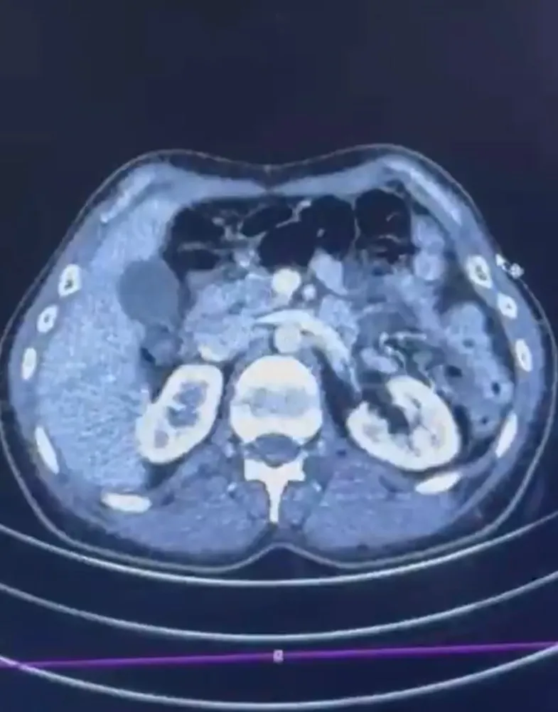 ÜLKEYE MİDELERİNDE UYUŞTURUCU GETİREN ŞAHISLAR YAKALANDI